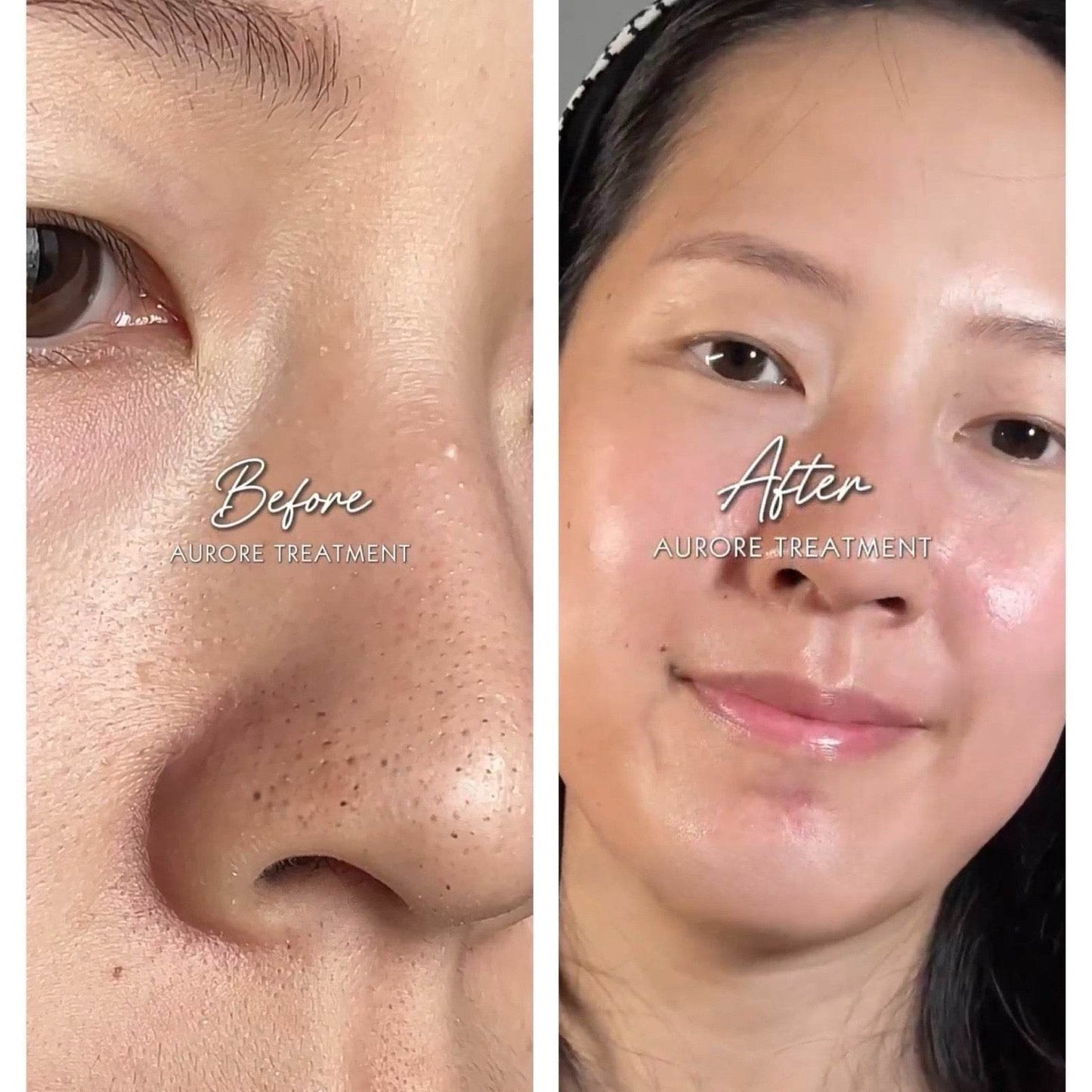 Aurore Rejuvenating Kit | Pore Vacuum + Rejuvenating Solution - belle femme