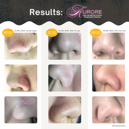 Aurore Rejuvenating Kit | Pore Vacuum + Rejuvenating Solution